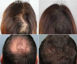                         Hair Meso Therapy (Hair... main image