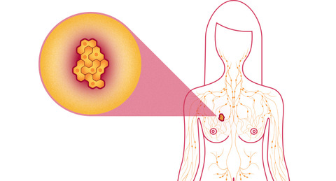 WORRYING TREND of BREAST CANCER in India?
Brea... main image