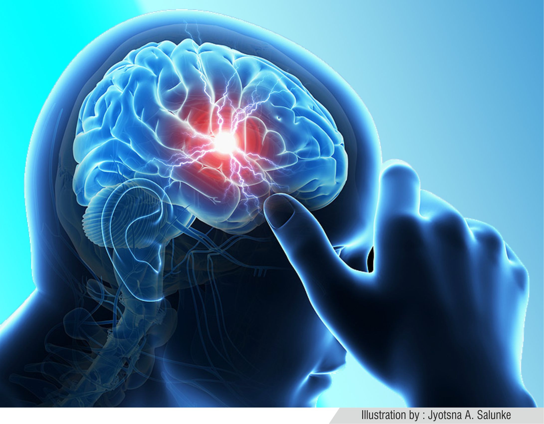 What is a stroke?
A stroke is a brain attack wh... main image