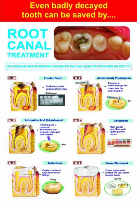 EVEN A BADLY DECAYED TOOTH CAN BE SAVED BY ROOT... main image