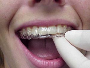 Do you want transparent retainers after orthodonti... main image