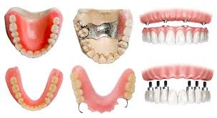 DENTURE
Gaps left by missing teeth can cause ma... main image