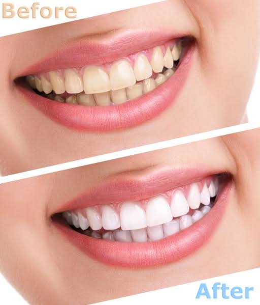 TEETH WHITENING/BLEACHING
Many people want to b... main image