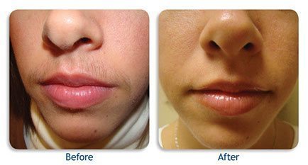 LASER HAIR REMOVAL TREATMENT 

Laser hair remov... main image