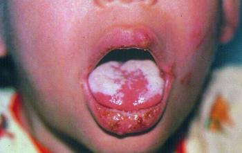 oral candidiasis is a fungal infection very common... main image