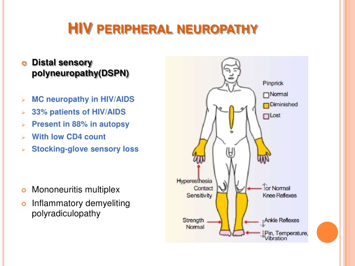 Nuropathic pain is common in hiv infected patie... main image