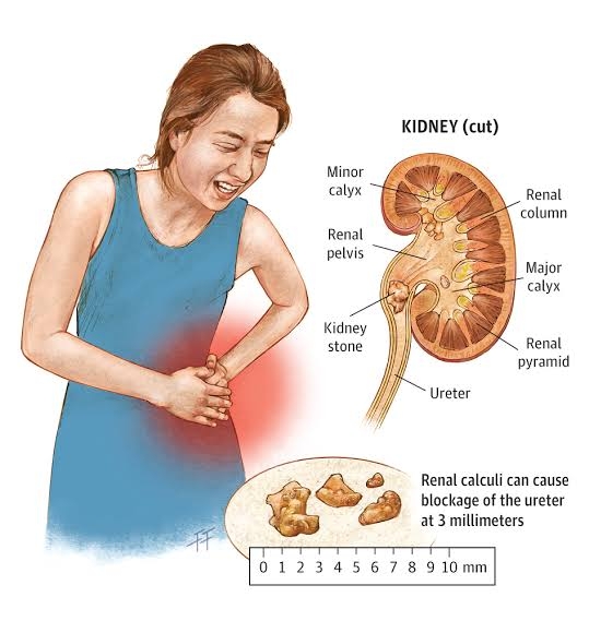 Suffering from kidney pain ?? Step into Siddhivina... main image