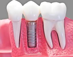dental implant 


dental implant treatment in saga... main image