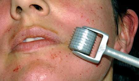 A dermaroller is a skin care device used to hel... main image
