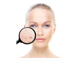 Acne Treatment

Acne is a chronic, inflammatory... main image