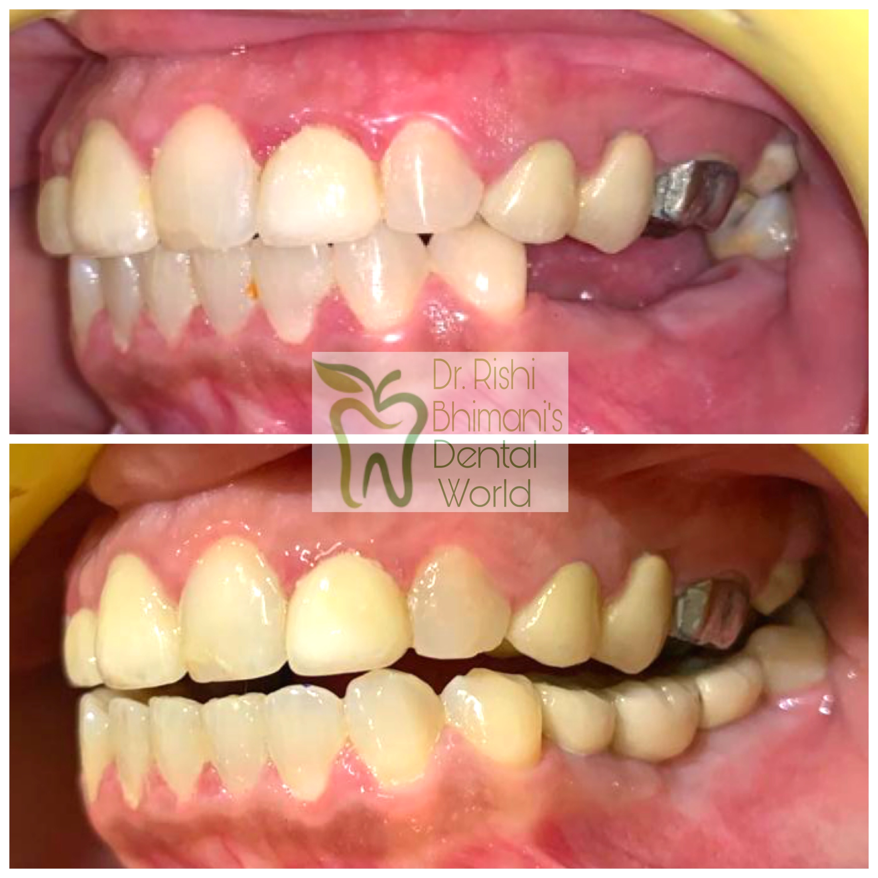 Replacement of missing molar and premolar teeth... main image
