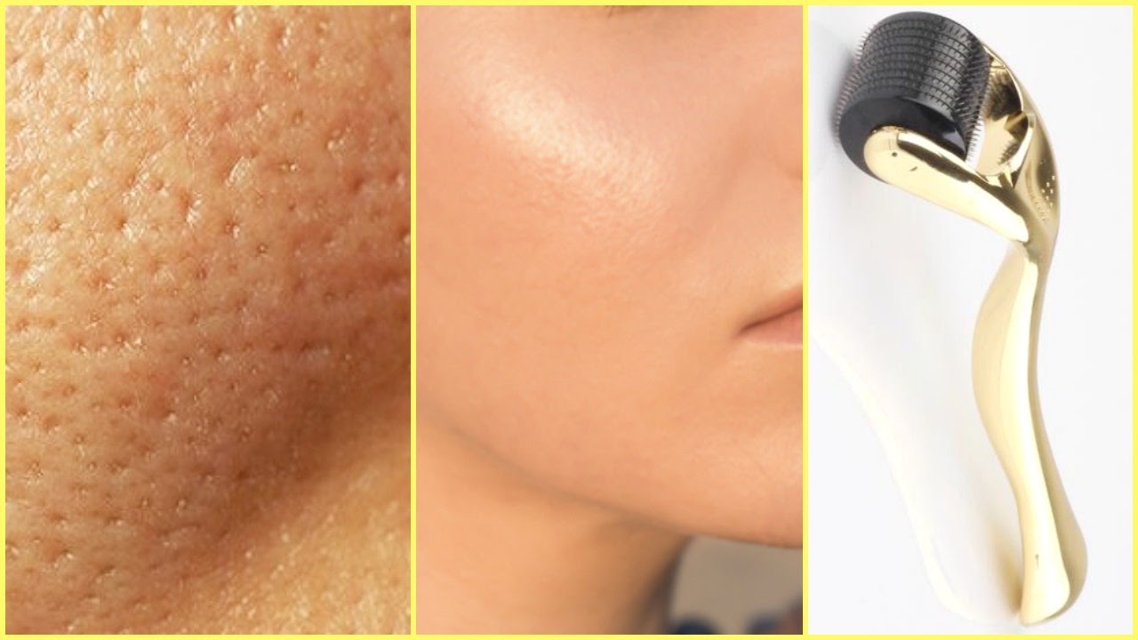 Derma Roller

Dermarolling is a skin treatment ... main image