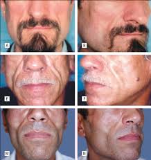 lipoatrophy seen with hiv drugs like stavudine ... main image