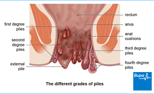 Laser piles treatment services

PILES also know... main image