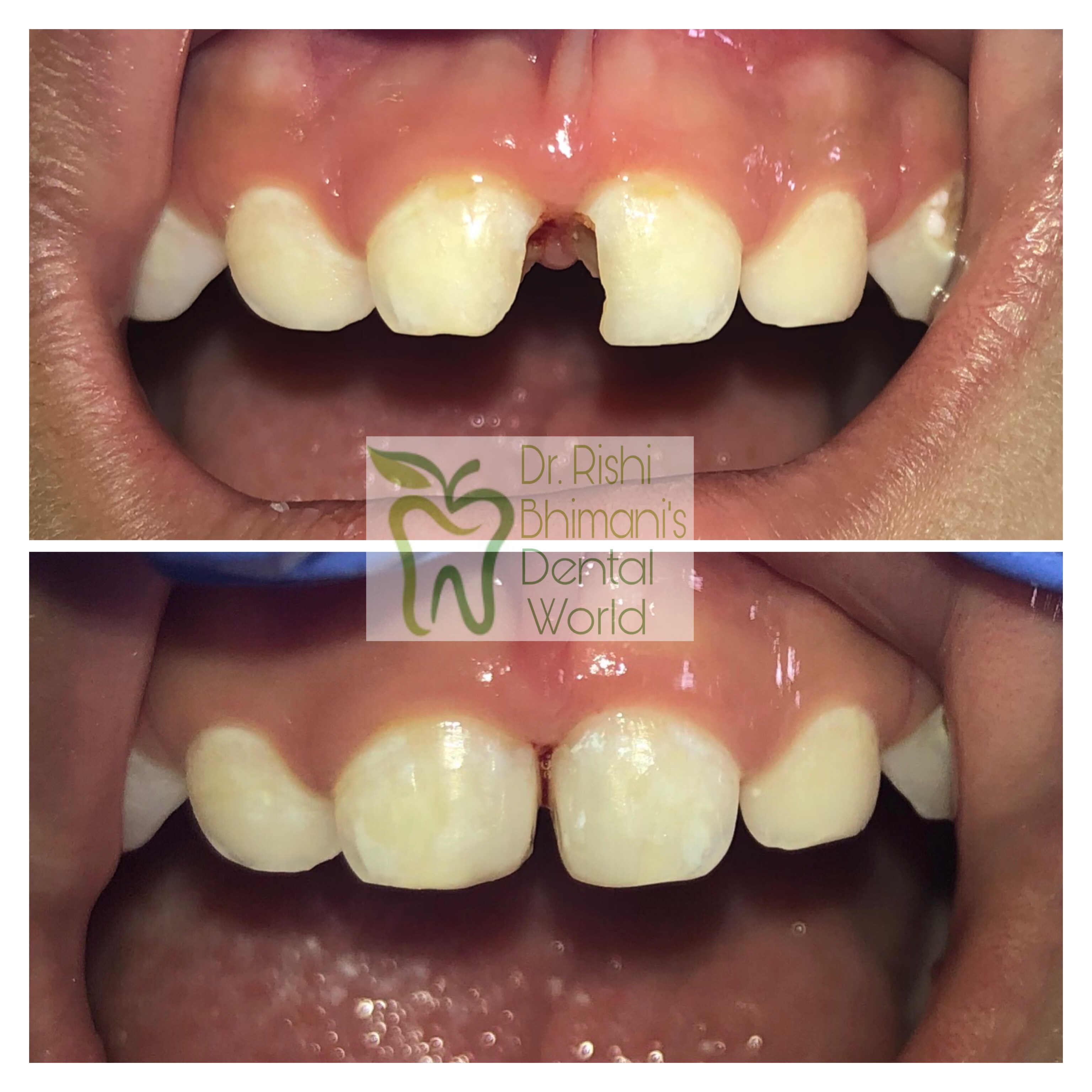 Kids dentistry for decayed and painful front te... main image