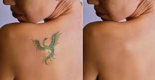 Tattoo Removal 

Tattoo removal is a procedure ... main image