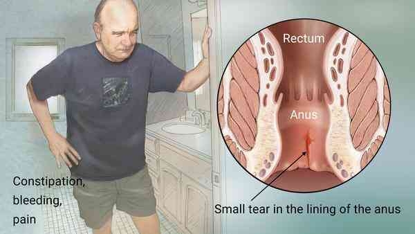 Best affordable Fissure treatment available....... main image