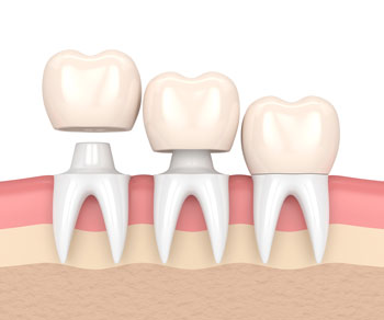 Caps & crown 
caps n crown dental treatment in vas... main image