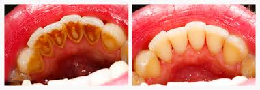 Get deep Scaling/polishing done at Chauhan's Denta... main image