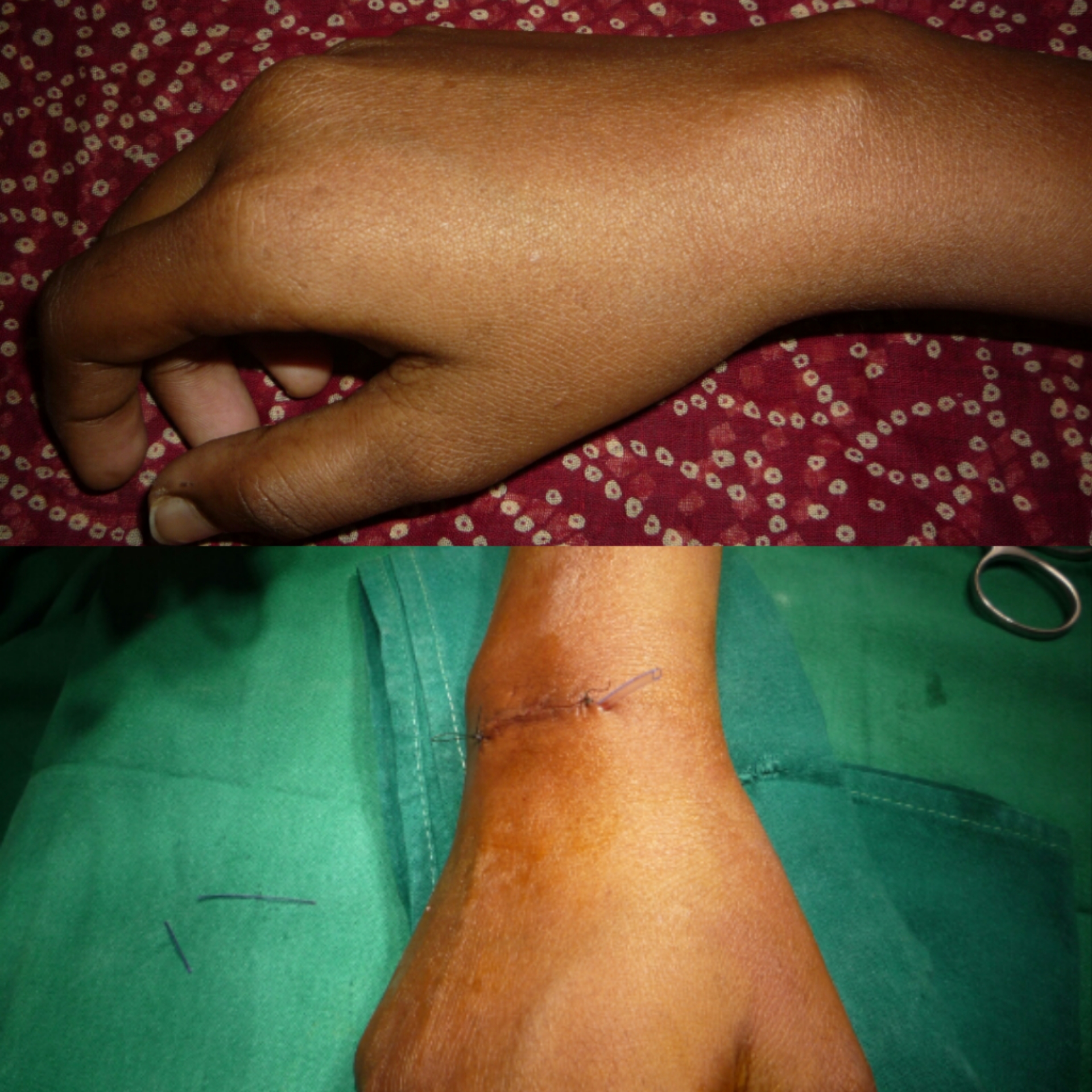 EXCISION OF GANGLION