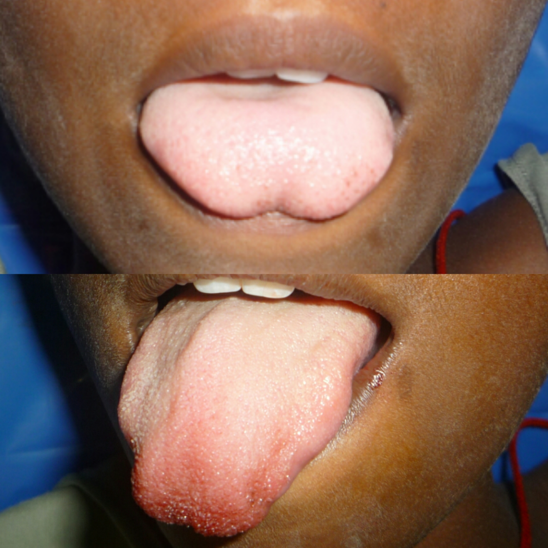 TONGUE TIE RELEASE D