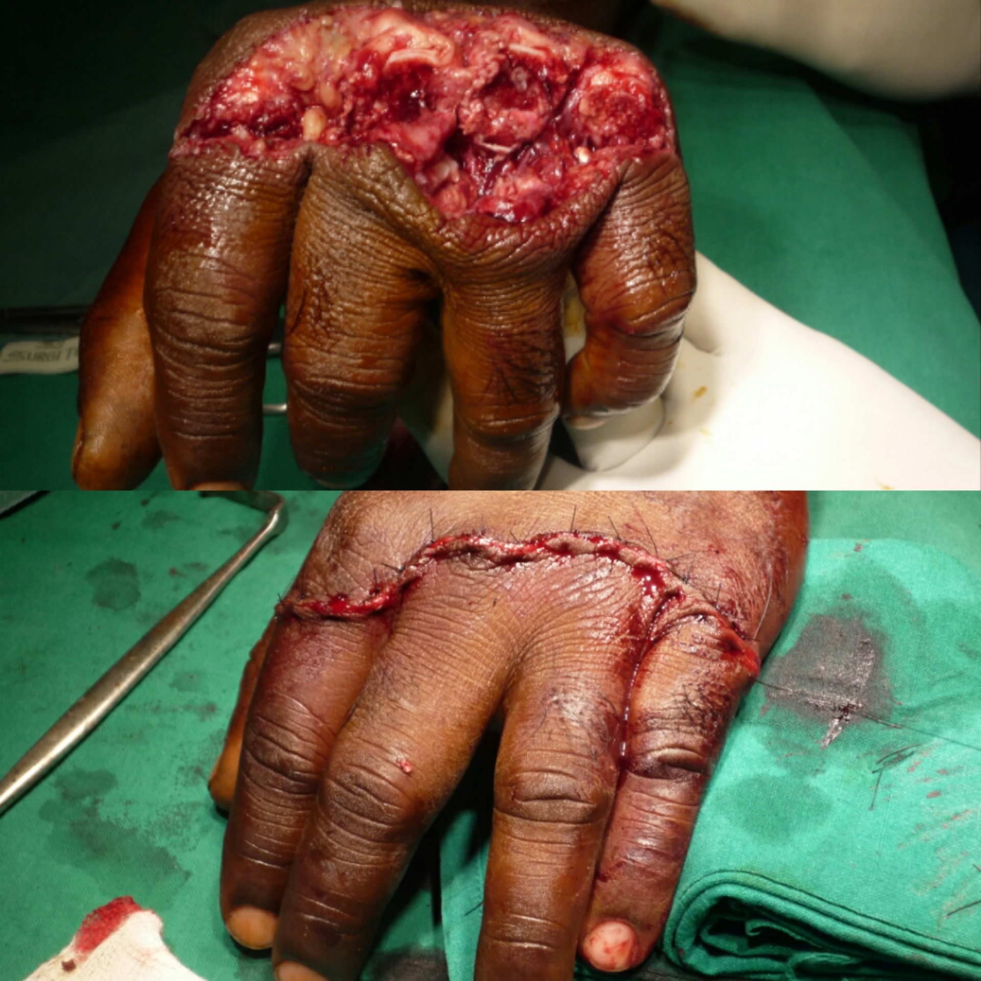 EXTENSOR TENDON INJ