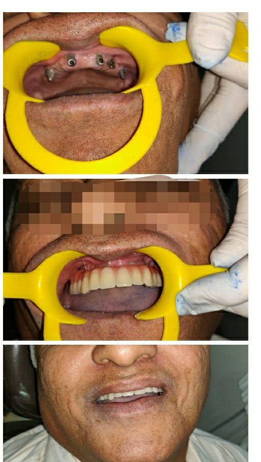Dental implants are safe and best solution for rep... main image