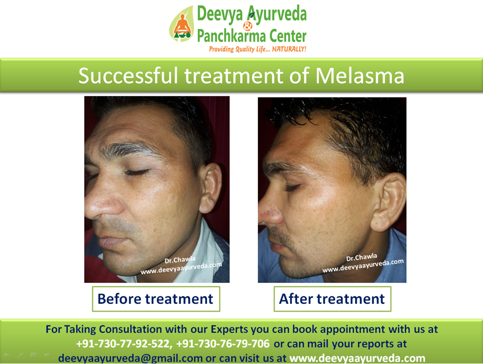 best ayurvedic medicine for acne