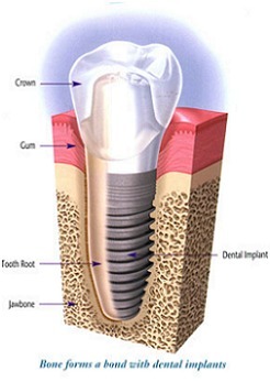 Dental Implants is most patient friendly and conse... main image