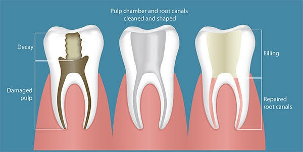 PAINLESS ROOT CANAL TREATMENT (RCT)
If you experie... main image