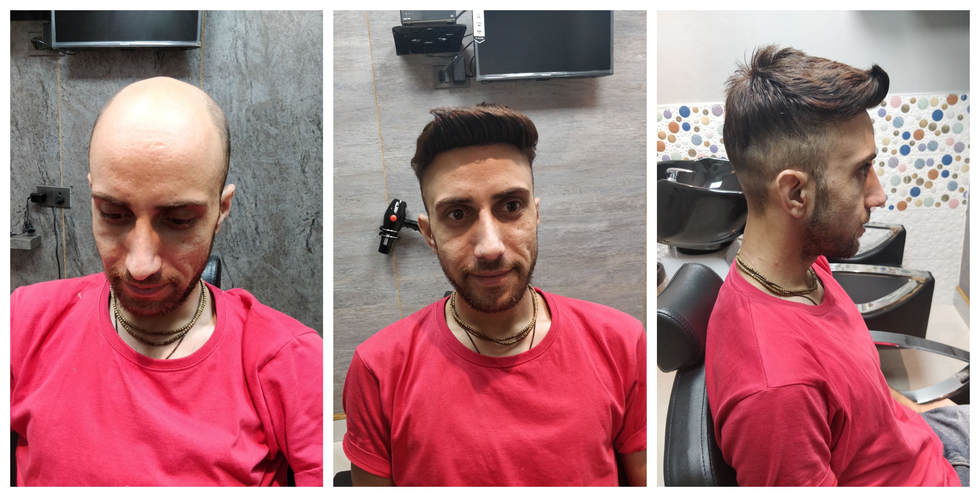 Non Surgical Hair Replacement In Gurgaon Hair Wigs Weaving