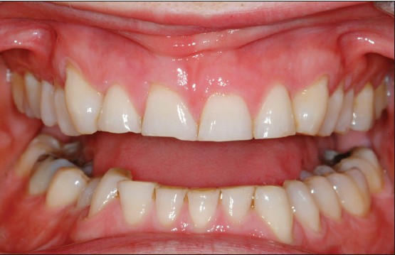 Teeth grinding can have serious impact on teeth an... main image