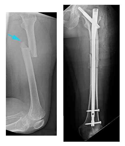 Fracture Treatment in Vesu

Tanish Hospital pro... main image