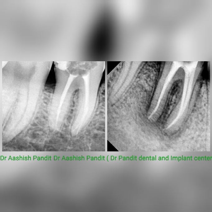 
Root canal or endodontic treatment is necessary w... main image