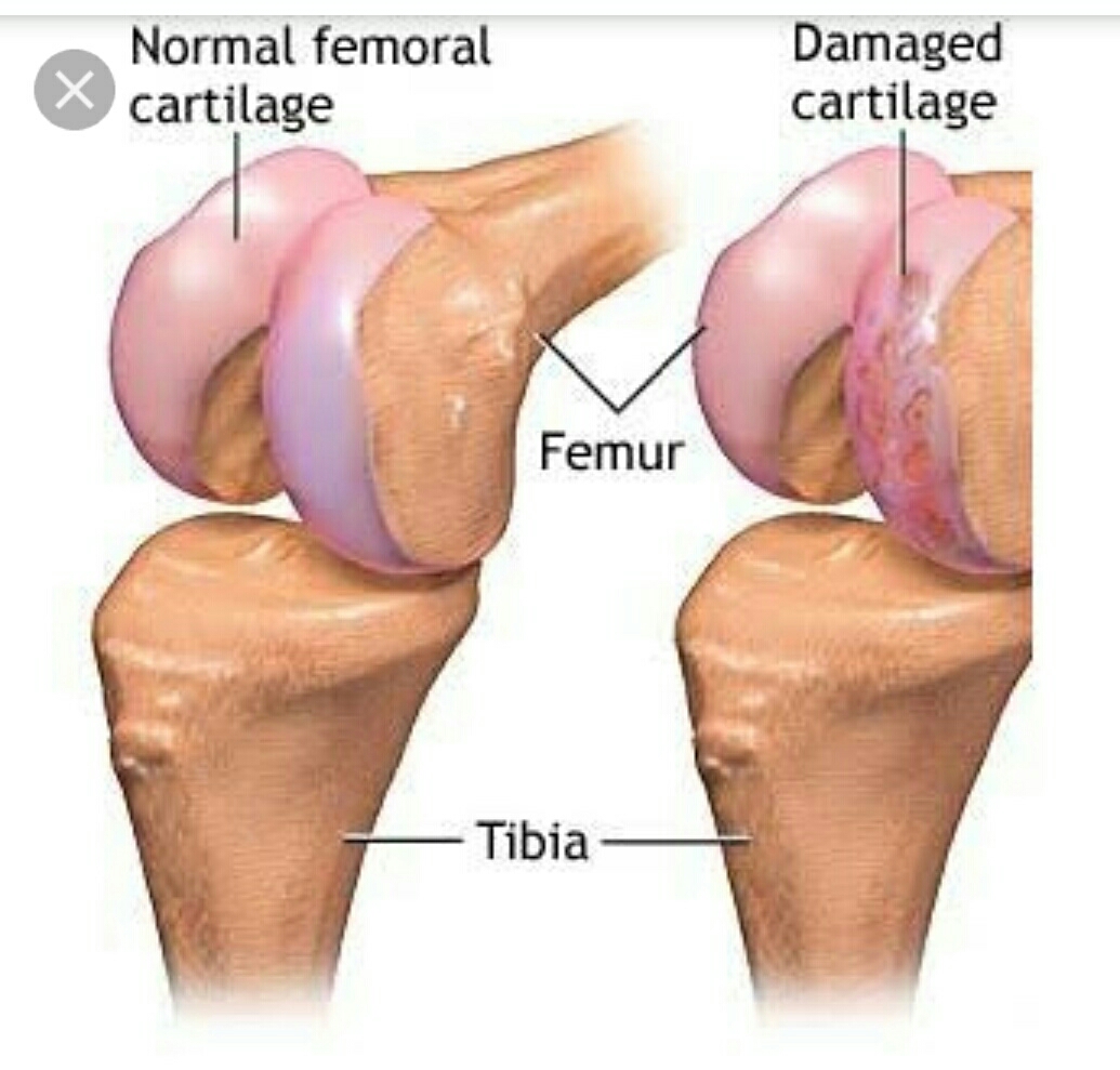 Cartilage is smooth part at end of bone helps i... main image