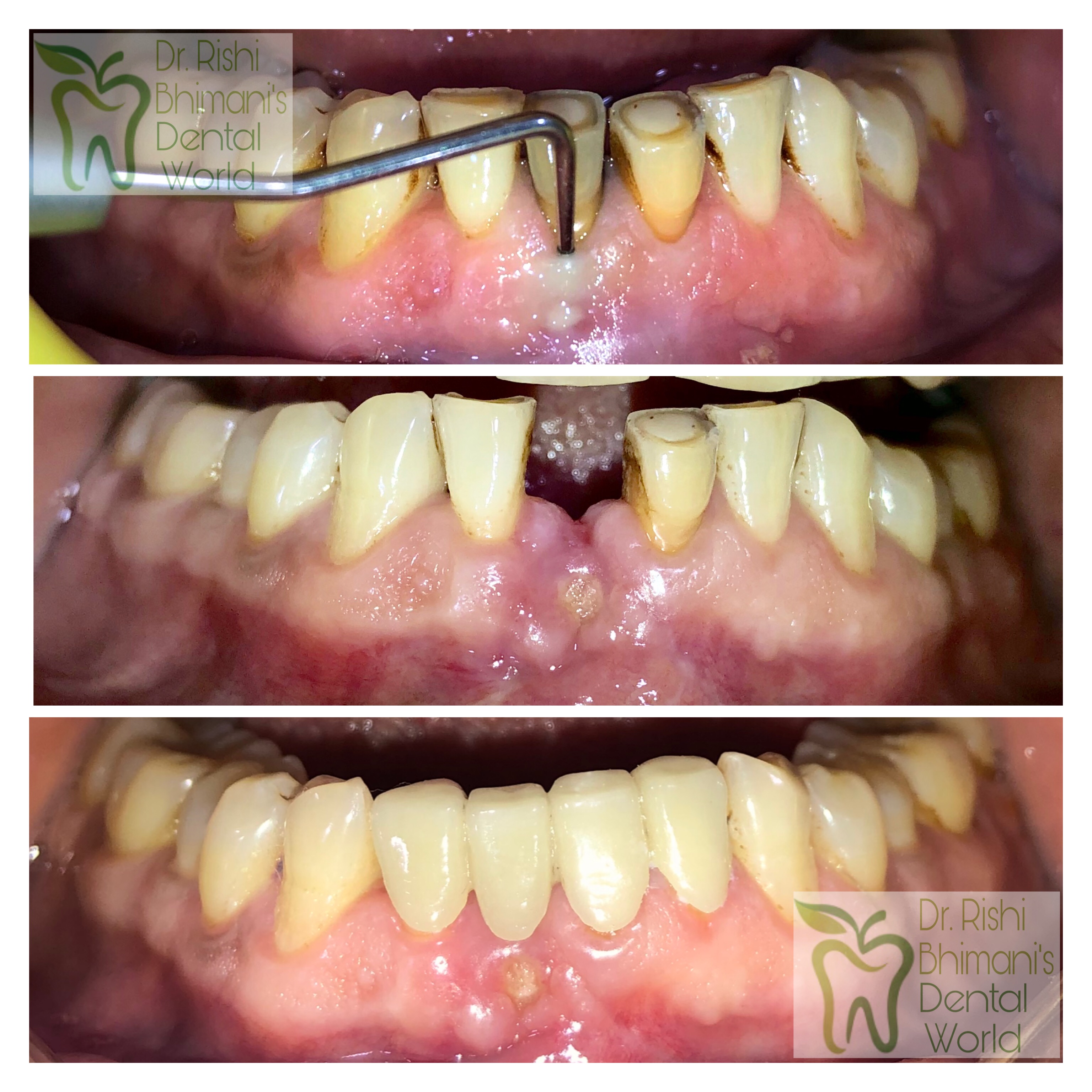 Ceramic crowns used to replace the fractured fr... main image