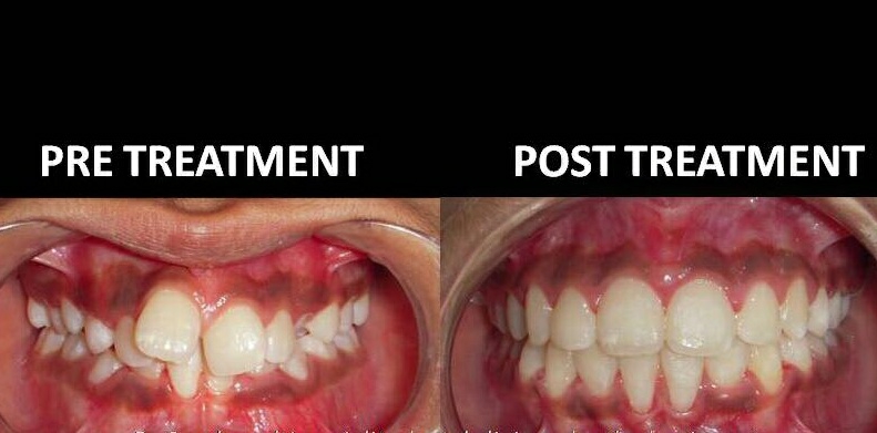 

Dental braces are appliances which are used to a... main image