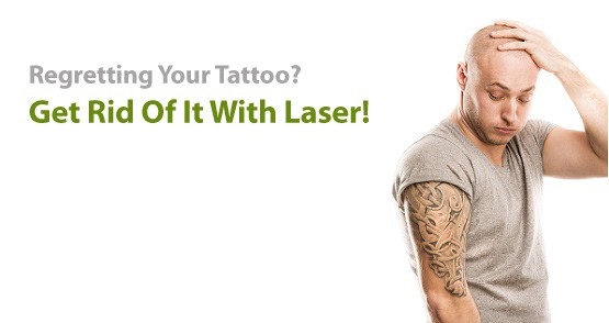 Laser Tattoo Removal