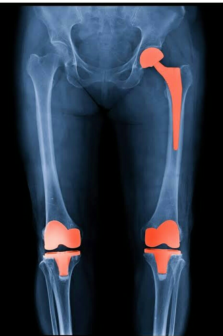 Replacing damaged worn joints with artificial j... main image