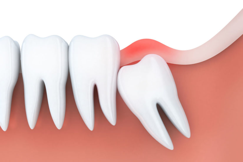 Wisdom teeth, or third molars, are the last perman... main image