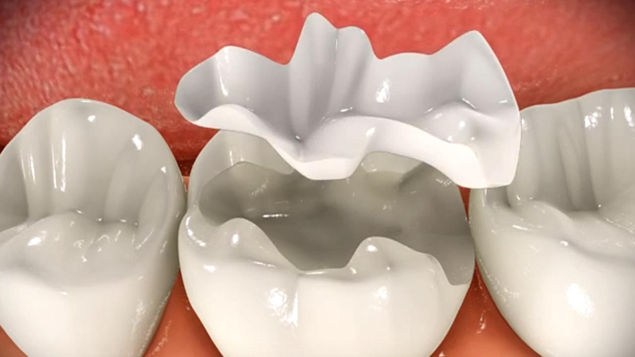 Dental Inlay is a lab made customized filling for ... main image