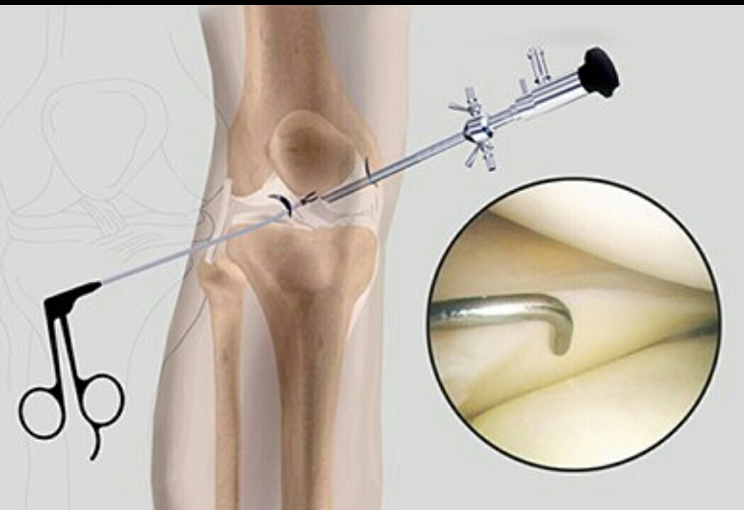 Arthroscopy is less invasive procedure with spe... main image