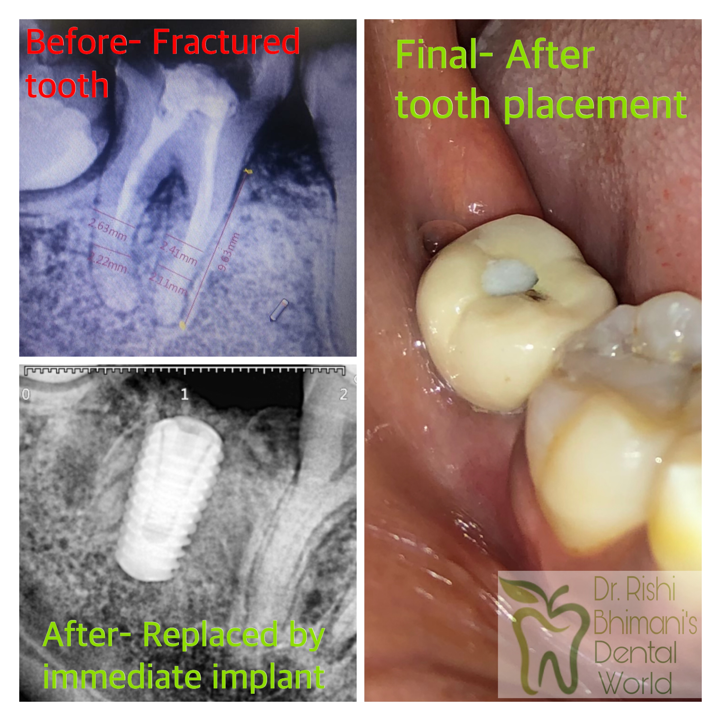 Fractured teeth that cannot be salvaged, have t... main image