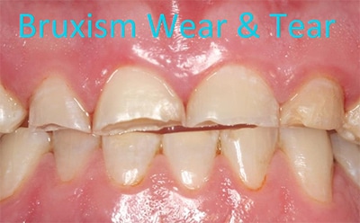 Do you feel you grind your teeth and all your fron... main image