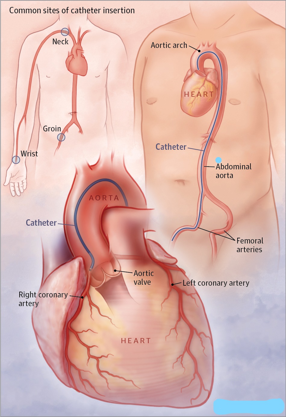 CARDIAC CATHERISATION :

OUR APPROACH:
Cardiac ... main image