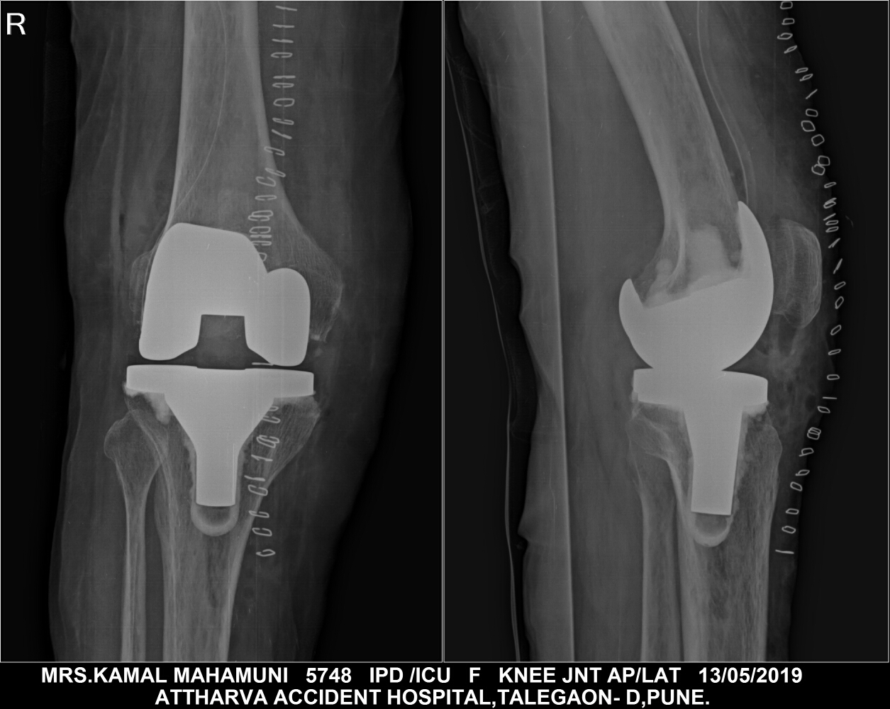 Pt xray after knee replacement surgery. main image