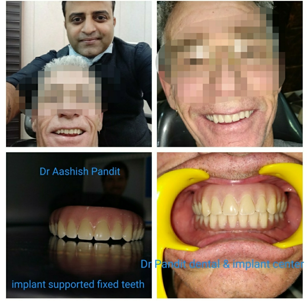 A dental implant is used to support one or more fa... main image