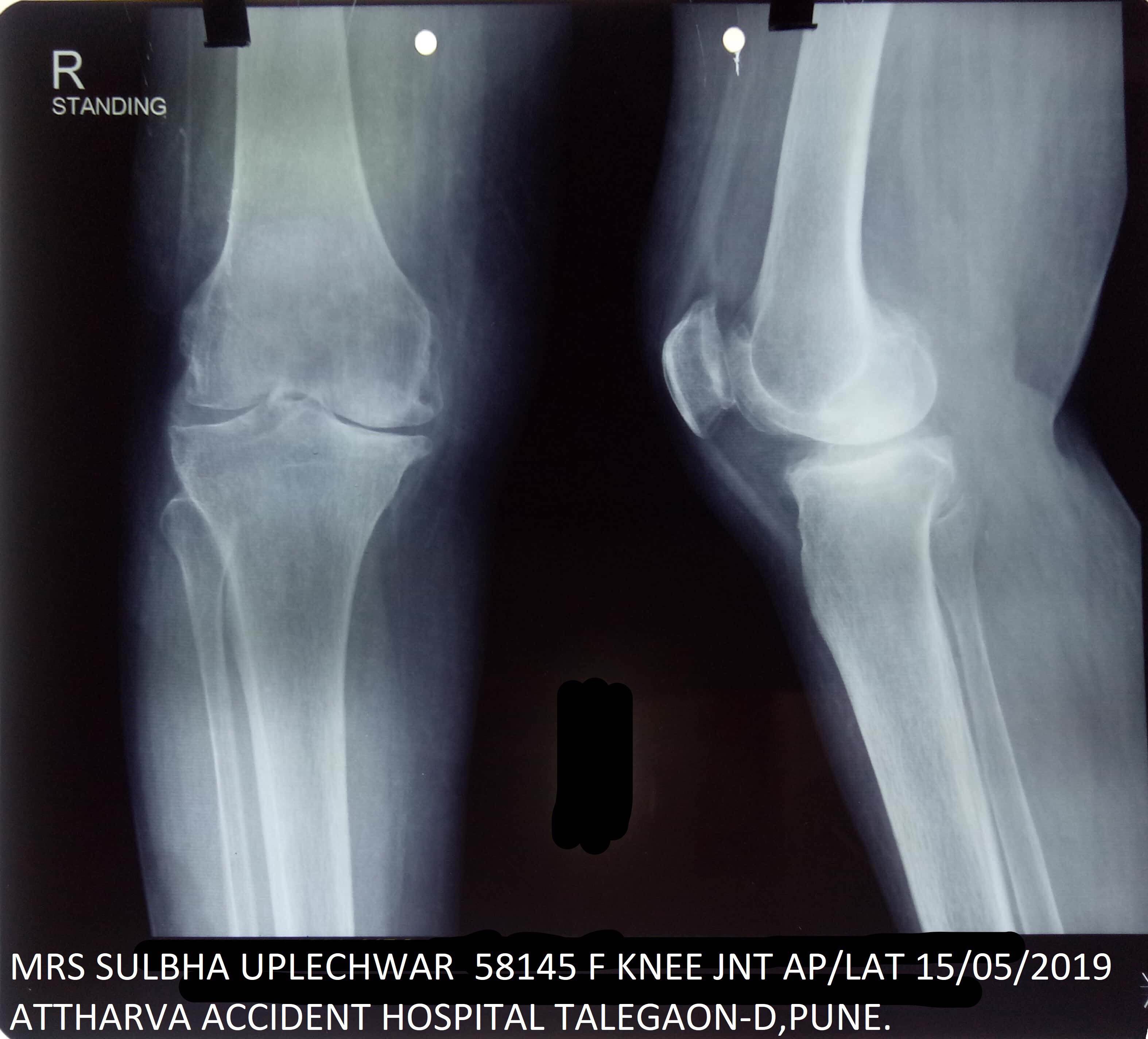 Before surgery knee x-ray  Mrs Sulbha main image