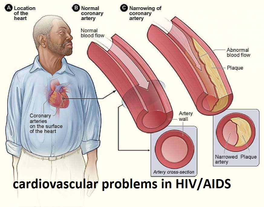 Patients living with HIV have an excess risk fo... main image
