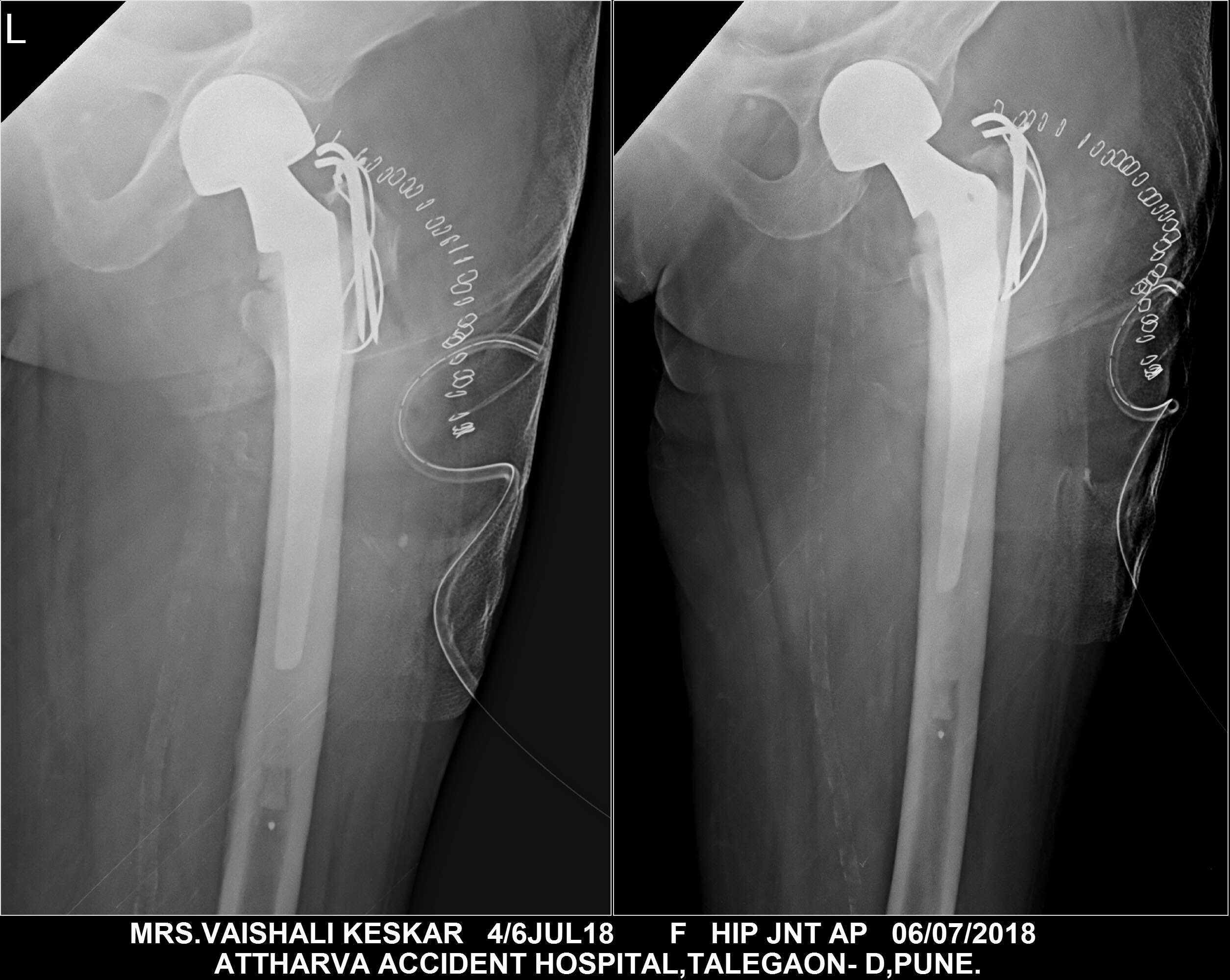 Post ops xray Mrs Vaishali Keskar main image